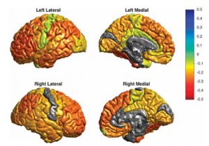Imatge de l'article sobre el primer mapa de les alteracions cerebrals en trastorn bipolar