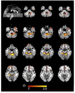Images of functional changes in diabetes patients' brains